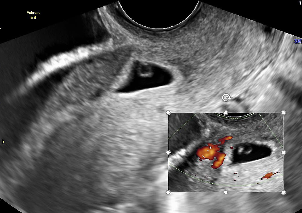 Ultrasound image of a Cesarean Scar Pregnancy