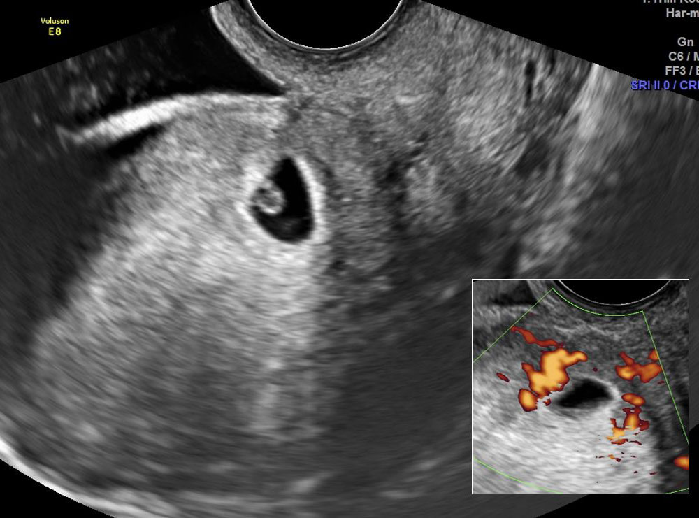 Ultrasound image of a Cesarean Scar Pregnancy