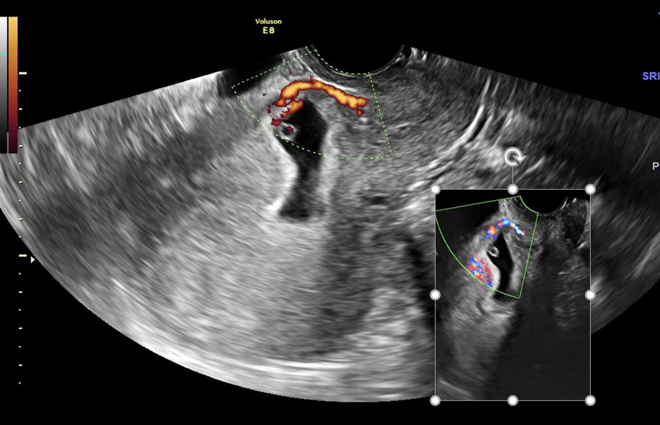 Transvaginal scan of a Cesarean Scar Pregnancy